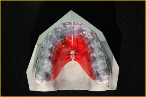 Split Plate