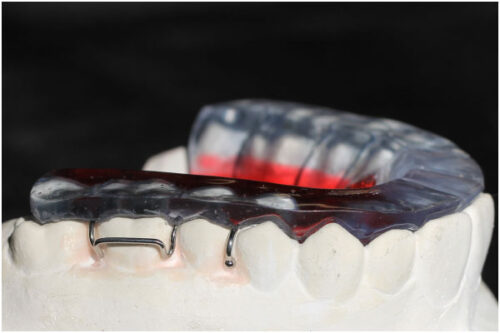 Coussin occlusal